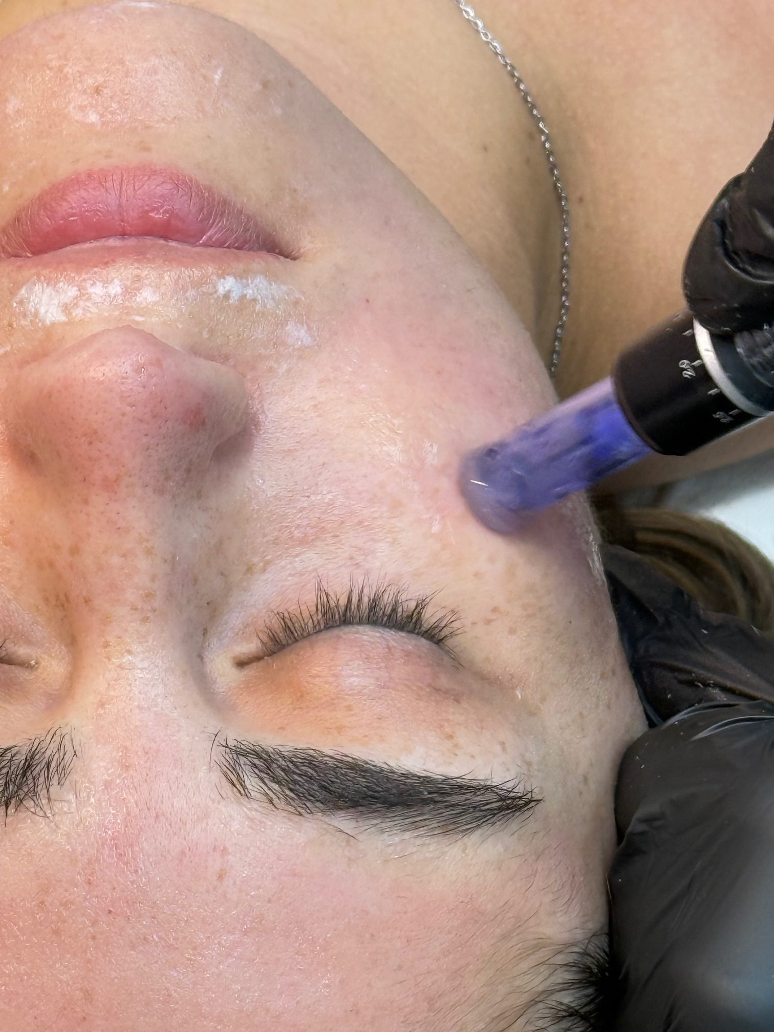 Collagen Rejuvenation Therapy